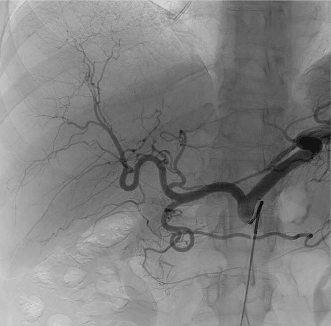 Initial celiac angiogram: distal GDA and RGA from proximal left hepatic