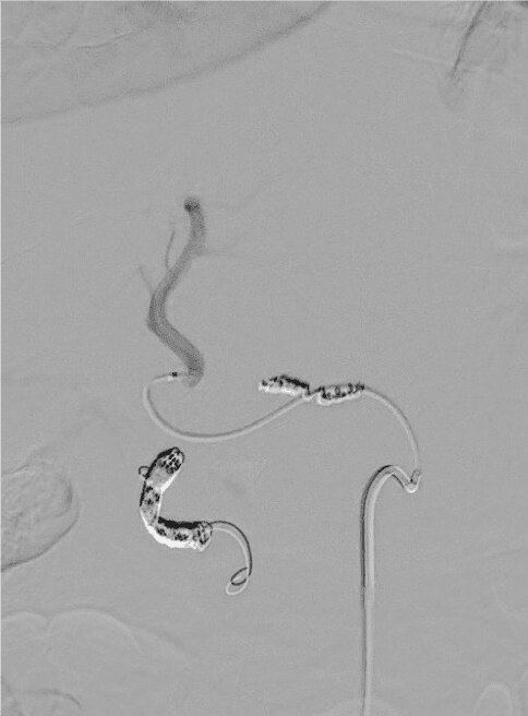 Post embolization angiogram of RGA demonstrating complete occlusion
