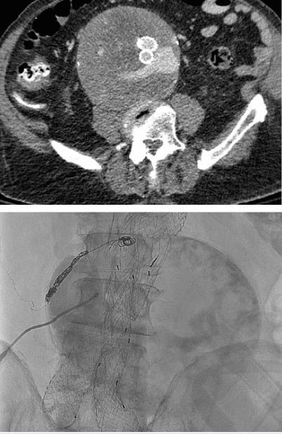 CTA and initial angiogram: Post IMA & pre lumbar and sac percutaneous