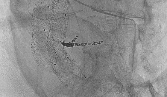 Selective catheterization and embolization of lumbar using Concerto coils 