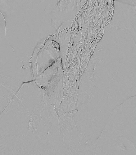 Final angiogram