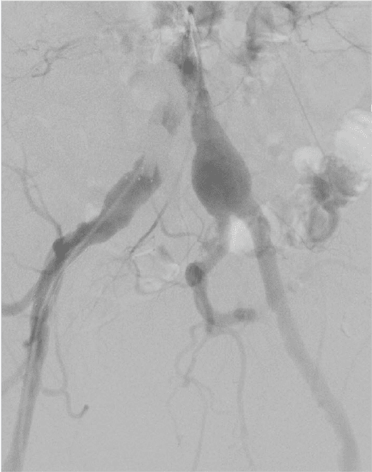 Pre stent-graft arteriography 