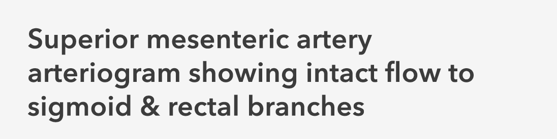 Superior mesenteric artery arteriogram showing intact flow to sigmoid & rectal branches 