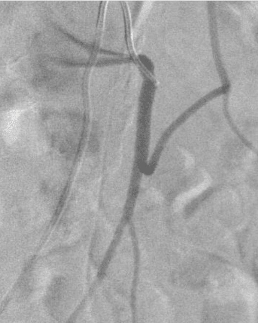 Selective IMA angiogram pre coiling 