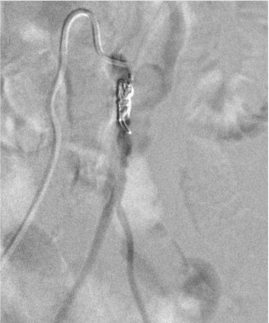 Angiogram after coil placement