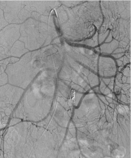 Superior mesenteric artery arteriogram showing intact flow to sigmoid & rectal branches