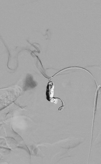 Post coil embolization of GDA patic